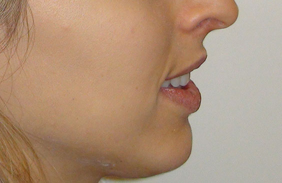 aorati orthodontiki meta nikos spyropoulos orthodontikos